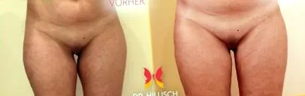 lézertechnikával