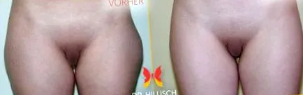lézertechnikával