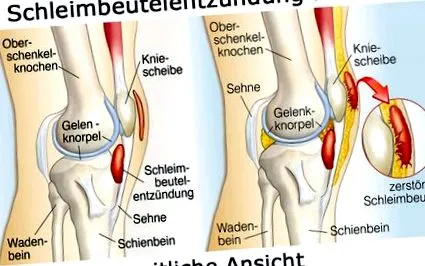 bursitis tünetei