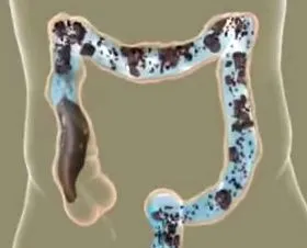 hidroterápia