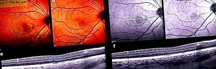macula