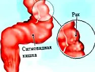 cancerul