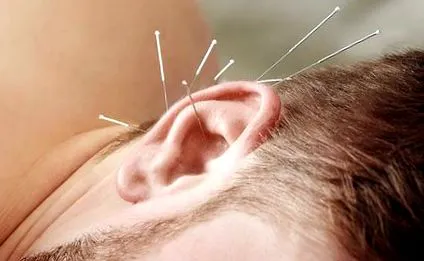 acupunctura poate