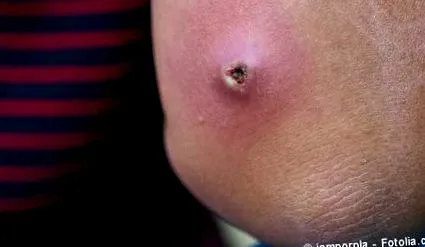 abscess