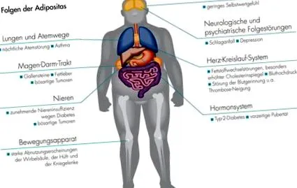 diabetologie-online Elhízás