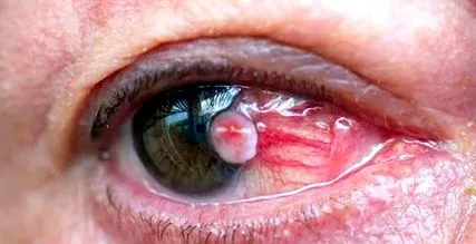 melanoma