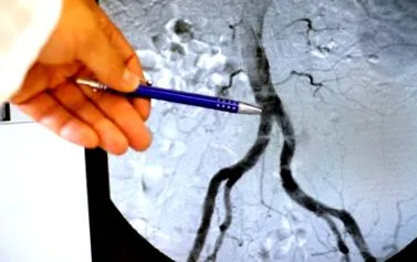 cauze arterială