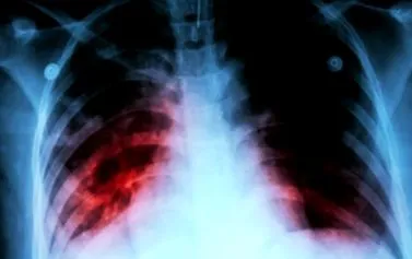 respiratorie cauze