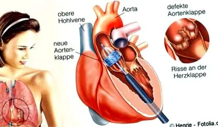 aorta aorta