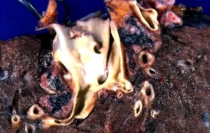 atherosclerosis