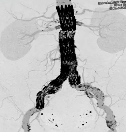 aneurysma