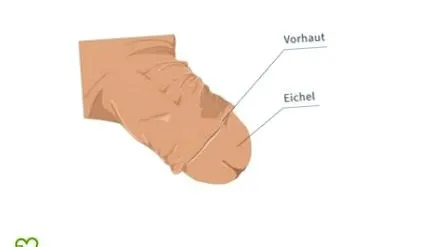 posthitis