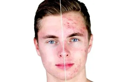 dermatitis