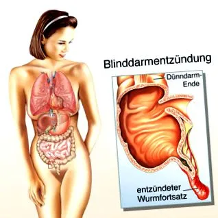 apendicele inflamat