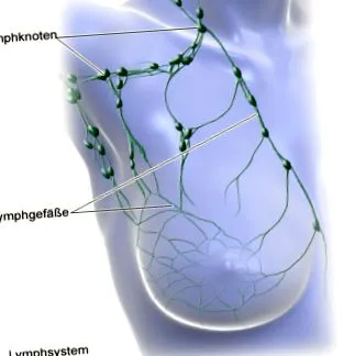 lymphedema