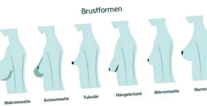 deformitásának