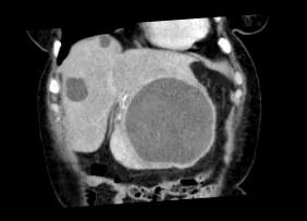 hepatic special