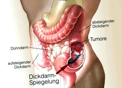 cancerul anal