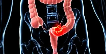 colon