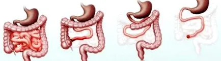 intestinală