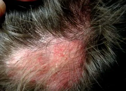 lupus