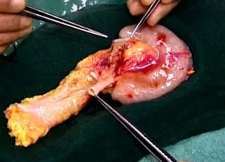 pancreasului
