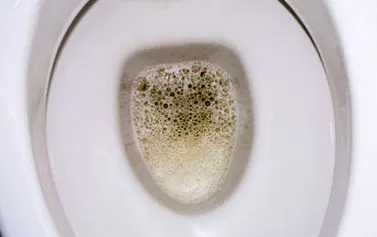 proteinuria okok