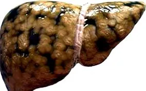 ficatul steatoza