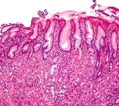 gastrice inflamarea