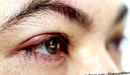 stye