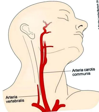 carotidă îngustarea
