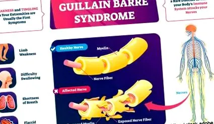 Guillain-Barré szindróma