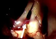 trigeminal