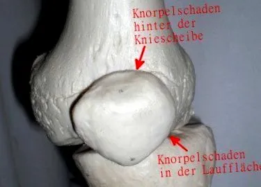 cartilajului