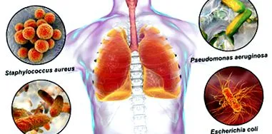 klebsiella infecție