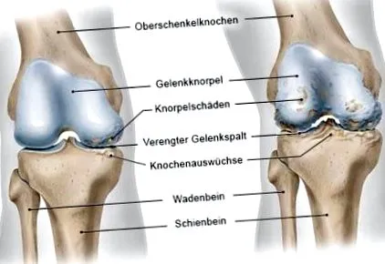 gonarthrosis