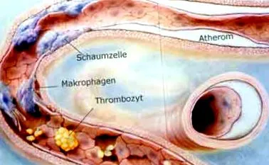 angina pectoris