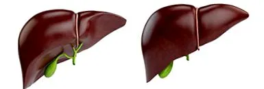 hepatică