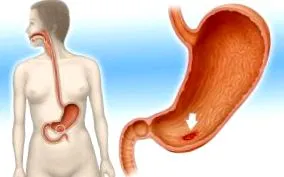 gastric