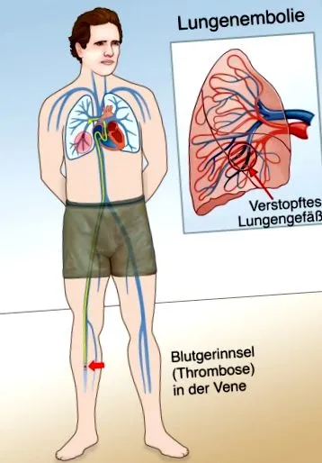 pulmonară