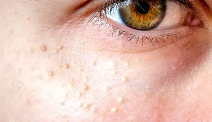 milia