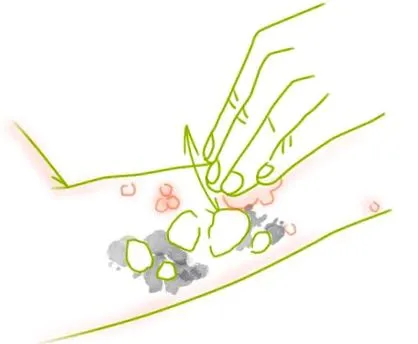 urticaria