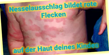 allergiás reakciót