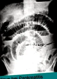 pancreatită