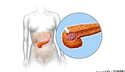 pancreatic
