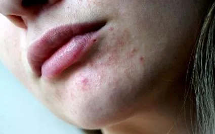 dermatitis