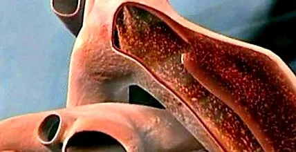 aortic