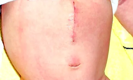 stenosis