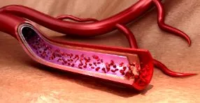 Sodium Phosphoricum