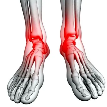 osteoartritei